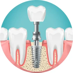 dental implants dental implants